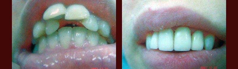 Przed / Po: Korekta protetyczna mini/maxi (wyglądu, zgryzu) – bez aparatu ortodontycznego